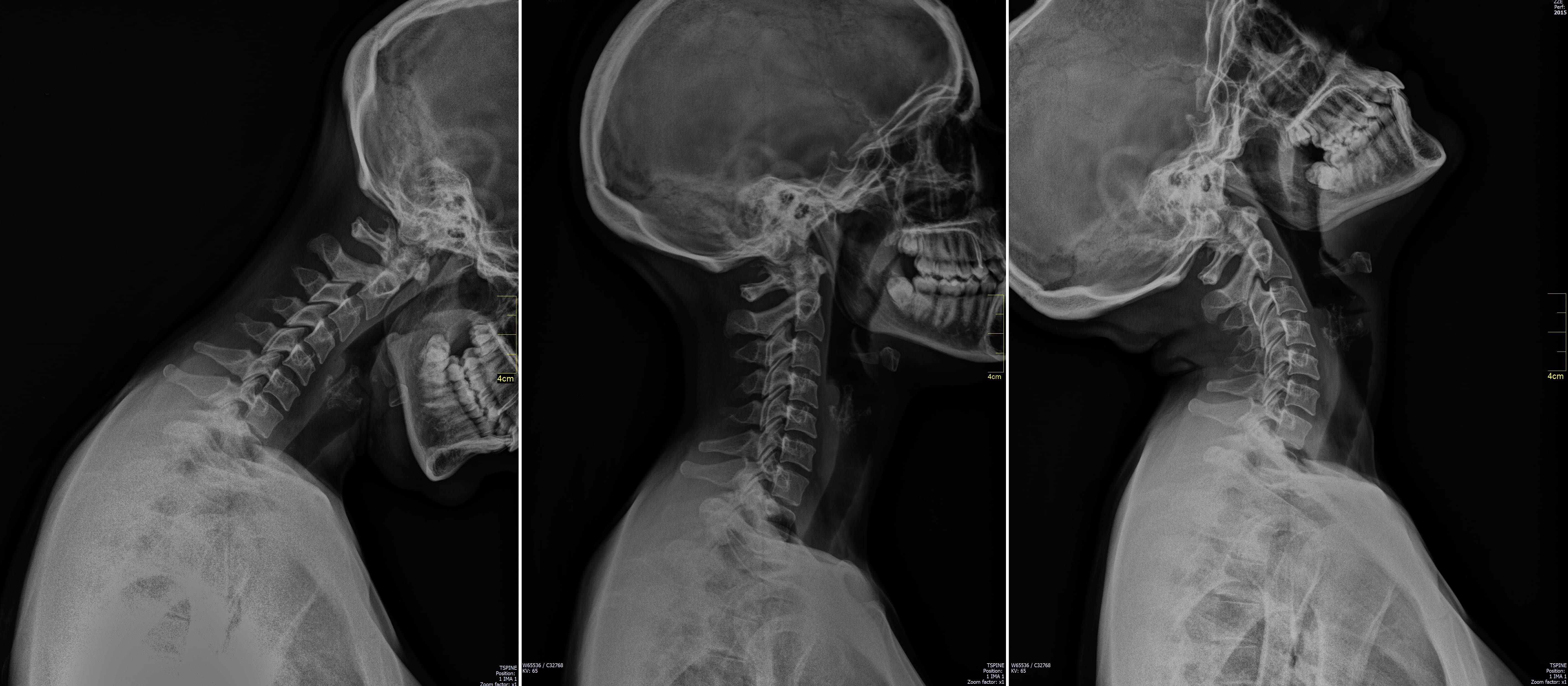 The Role of Biomechanics in Severe Injury Cases – Webinar